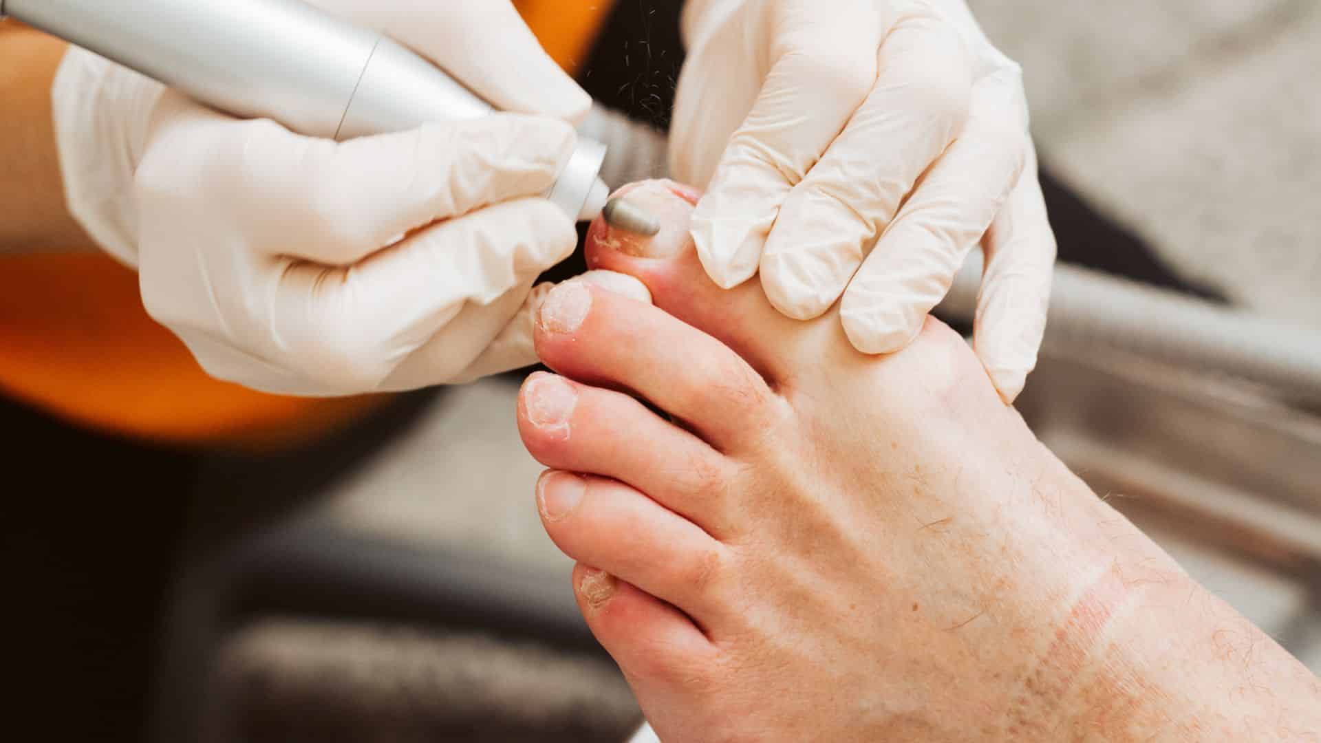 Advanced foot care nail treatment by HomeCare on Wheels clinical team